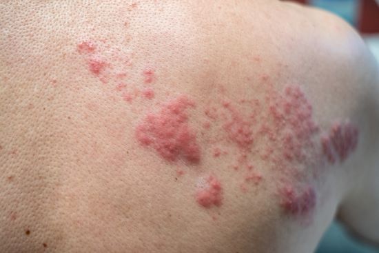 Shingles rash and blisters on teen's back