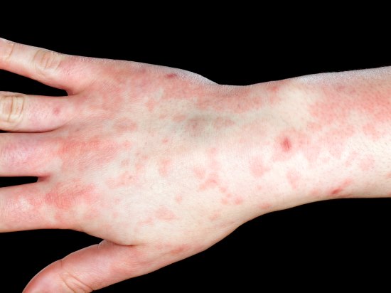 Close-up of the hand of a patient with a rash caused by an Epstein-Barr virus infection. 