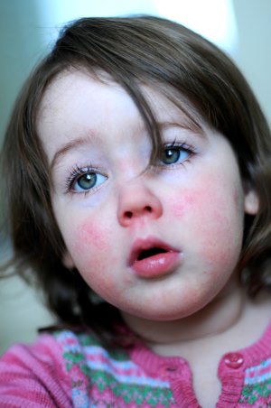 2 year old girl with scarlet fever rash on face