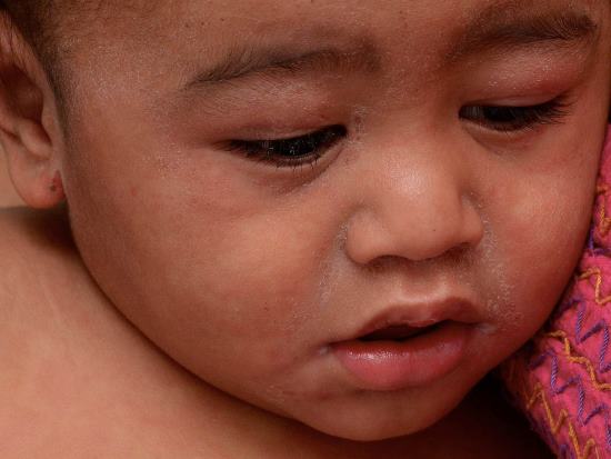 Measles on child's face