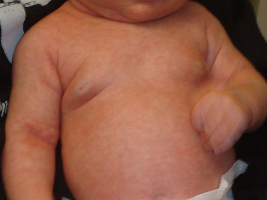 Roseola rash on baby's chest