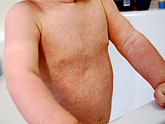 Rubella rash on child's chest