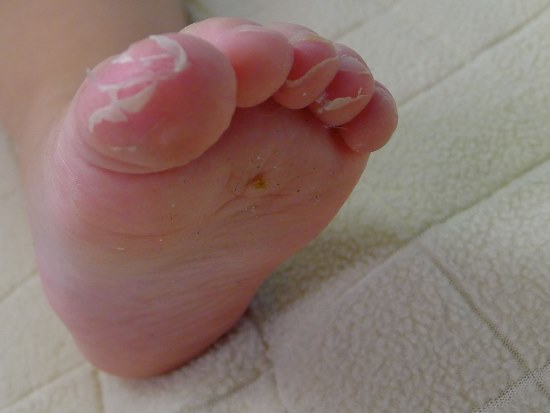 Baby's foot with peeled skin