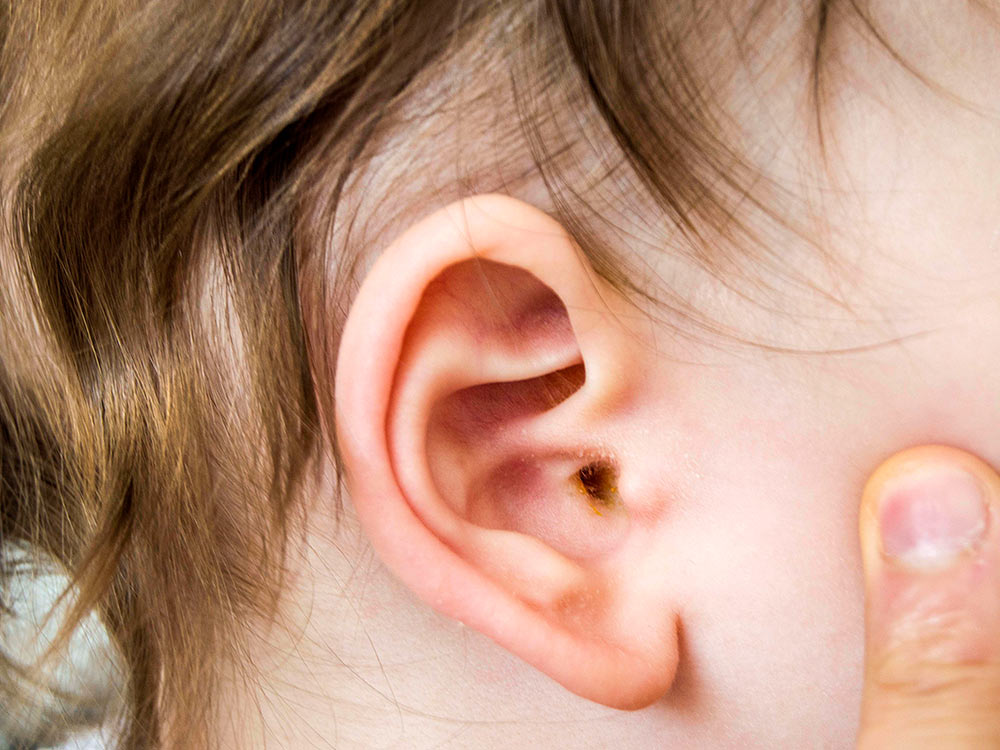 External Ear Infection Or Otitis Externa Raising Children Network