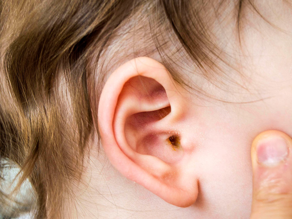 Ear wax: children & teens