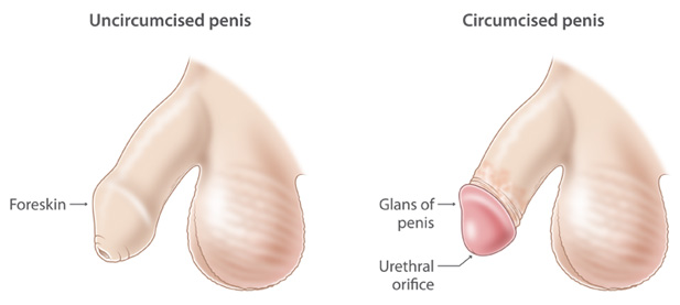 picture of uncircumcised and circumcised penises