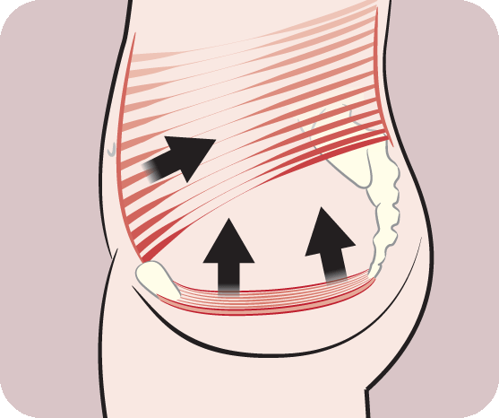 3 Ways to Stop Urine Leakage when Coughing - wikiHow Health