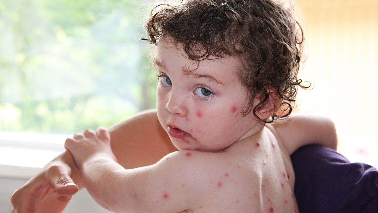Chickenpox in children and teenagers 