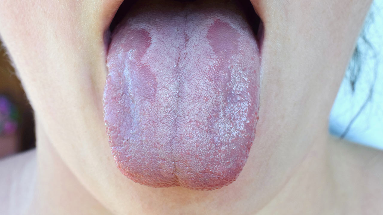 candidiasis throat