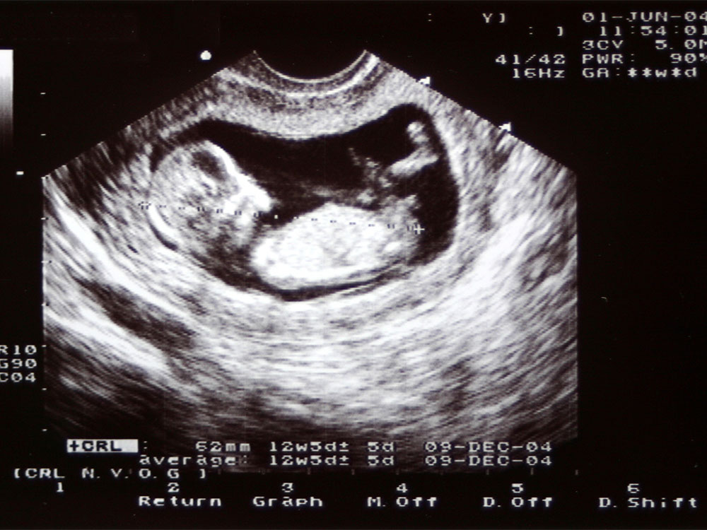 At 4 weeks pregnancy scan Early Pregnancy