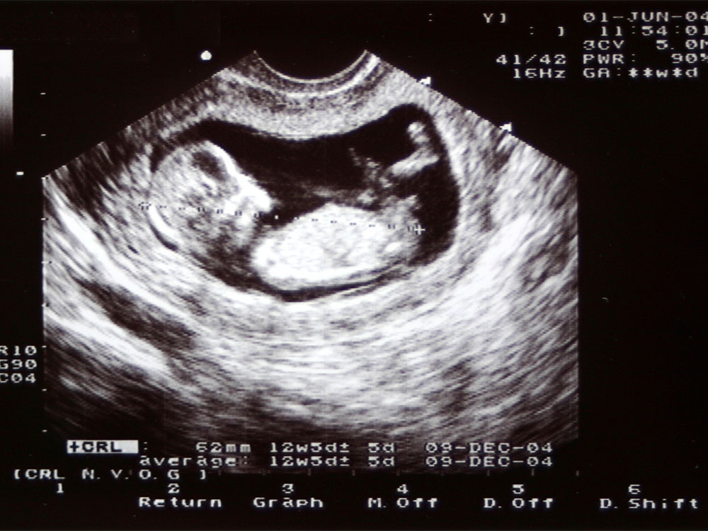 12-week ultrasound scan in pregnancy