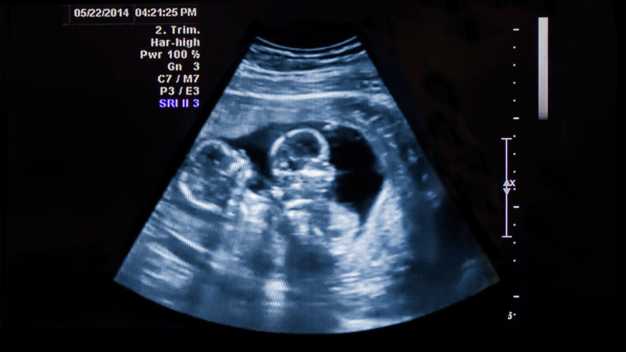 twins ultrasound 6 weeks