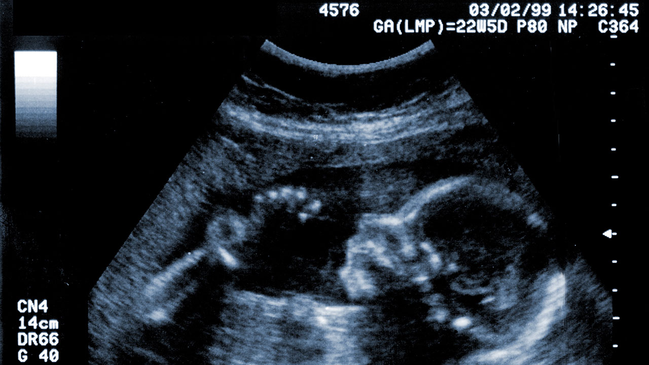 spina bifida ultrasound 13 weeks