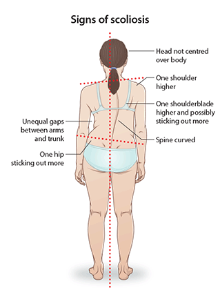 Image demonstrating the signs of scoliosis