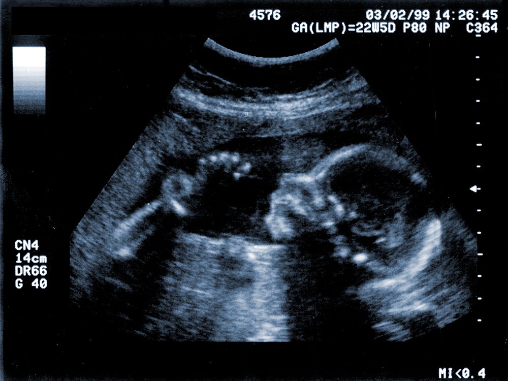 ultrasound scan