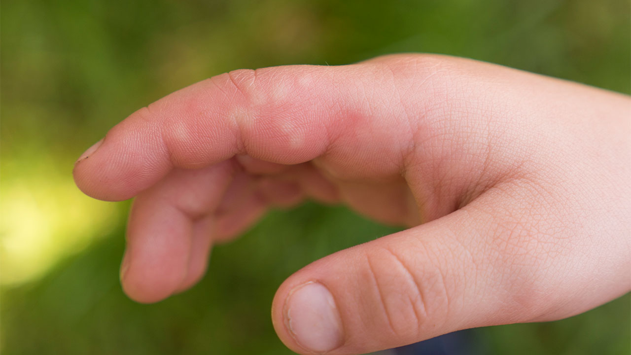 Allergic reaction symptoms on hands