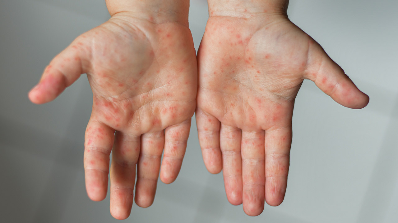 rashes on hands