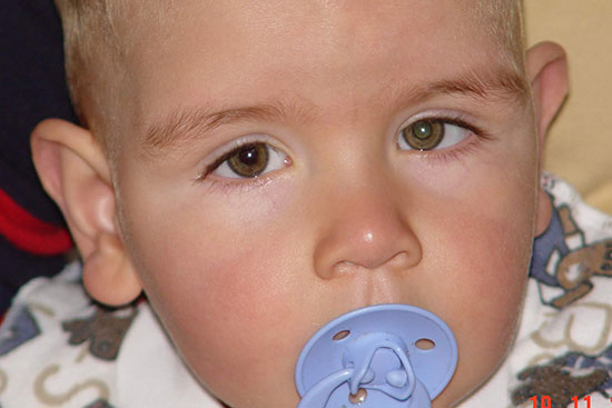 This image shows how white pupil might look in photos. The child’s right eye has a red pupil, which you often see in photos. The child’s left eye has white pupil, and you can see a bright white reflection.