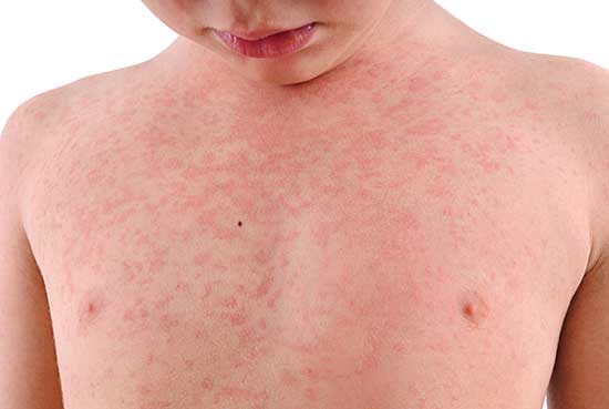 Boy with large patch of small, raised, red spots on his chest