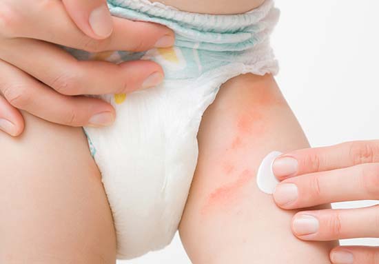 Red, sore nappy rash on baby's thigh