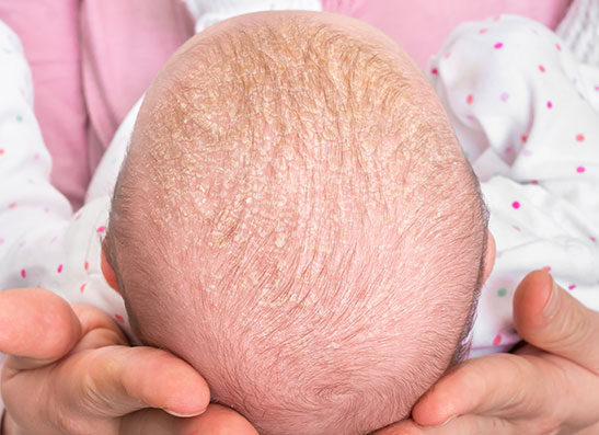 Baby's head showing cradle cap