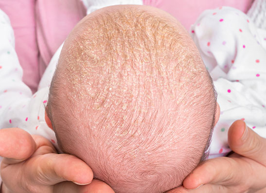 Dandruff in 4 2024 months old baby