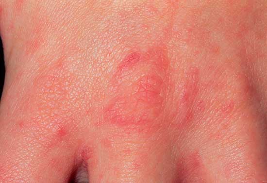 Scabies skin infection seen as small scaly swellings on the skin of the hand