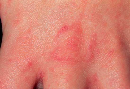 RACGP - A red scaly rash to the groin