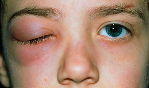 Face of an eight-year-old boy showing one eye inflamed and shut due to orbital cellulitis.