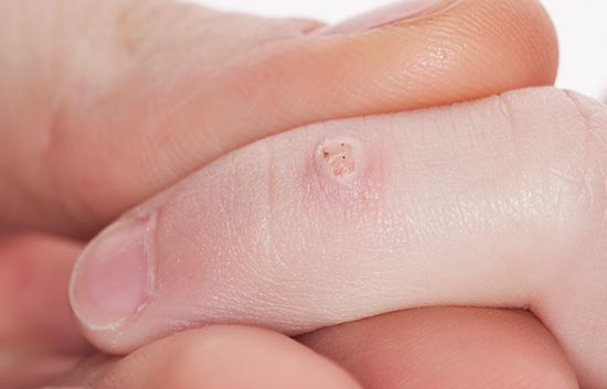 wart virus on fingers
