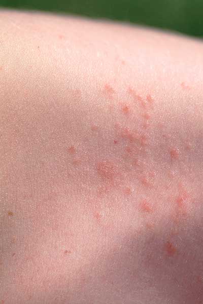 mild heat rash legs