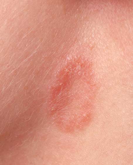 Tinea Corporis Neck Ringworm Causes Symptoms And Treatment FAHDZ