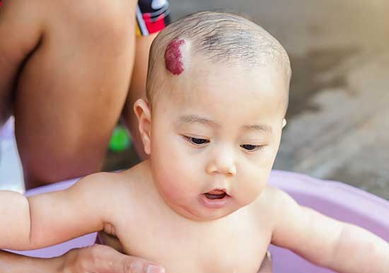 Large, raised strawberry birthmark on baby's temple