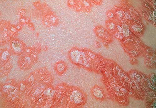 Close-up of scaly, pink and silvery psoriasis plaques