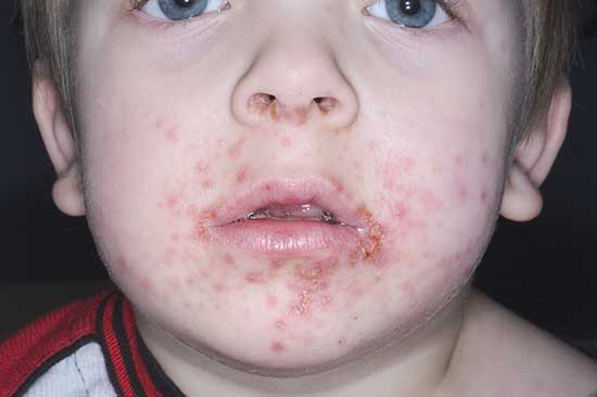 Raised, pimple-like impetigo sores on child's chin and crusty sores around the mouth and nasal area