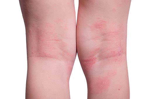 Eczema on white skin, showing as itchy-looking, red patches behind a child's knees
