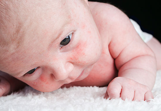 Small raised spots on newborn's cheeks and forehead
