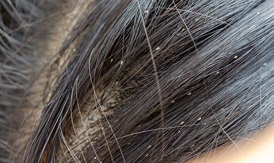 Oval-shaped lice eggs and lice clinging to hair shafts