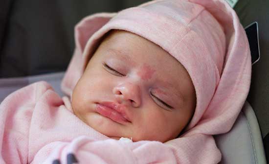 Flat, red marks on baby's eyelid and bridge of nose