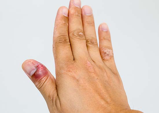 Fingernail infection with dark red broken skin around nail bed, exposing the flesh underneath.