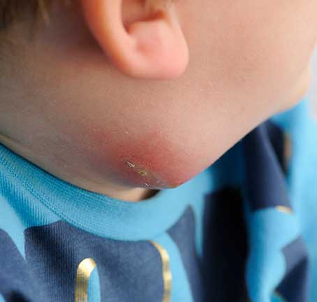 Young child with red swelling and small scab on the skin of his neck.