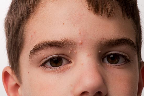 Small, flesh-coloured bumps on a 7-year-old boy's forehead and nose bridge