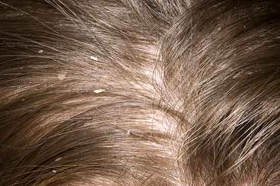 Flakes of dead skin, or dandruff, in the hair of a 13-year-old girl